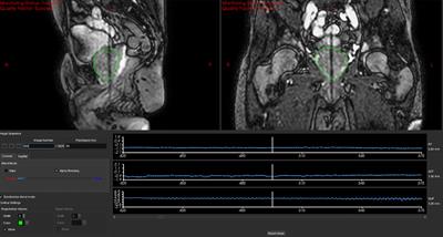 Simulating an intra-fraction adaptive workflow to enable PTV margin reduction in MRIgART volumetric modulated arc therapy for prostate SBRT